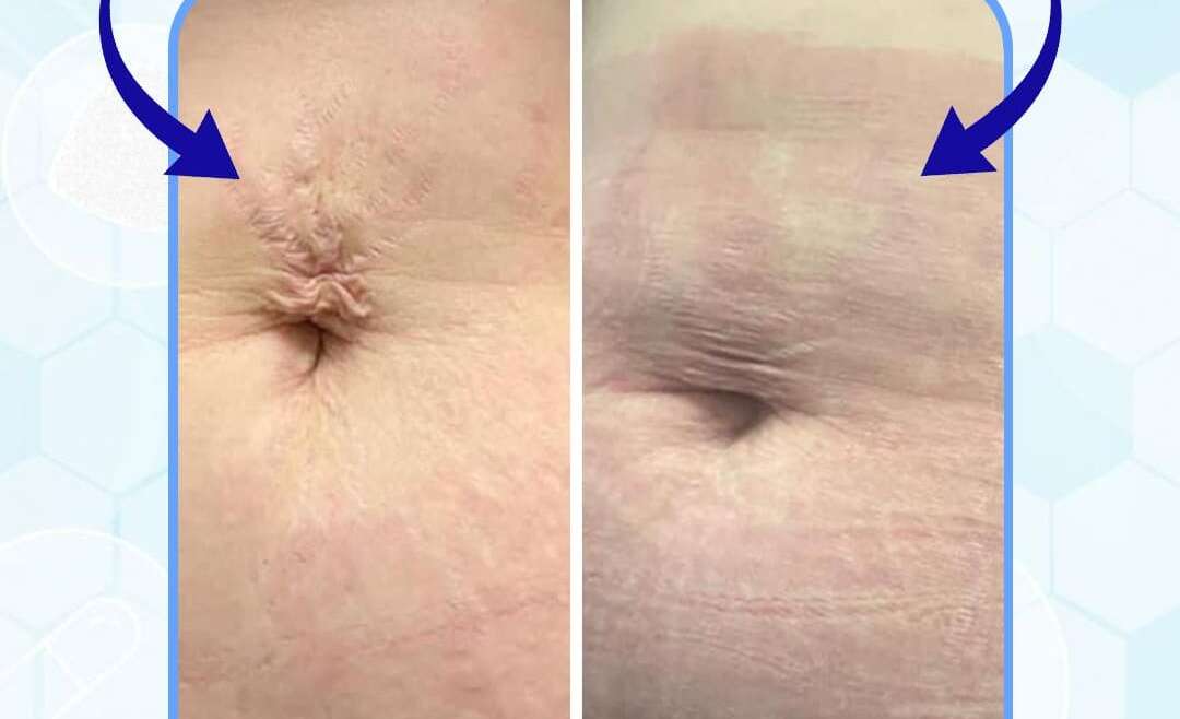 Stretch Marks
