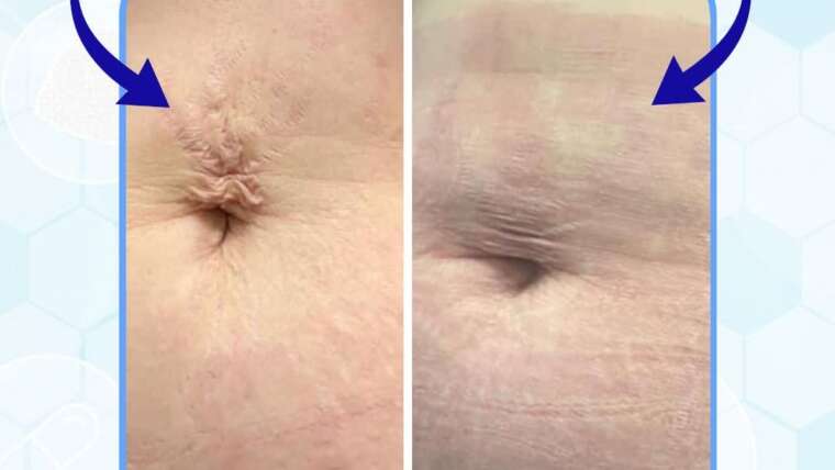 Stretch Marks Treatment in Navi Mumbai