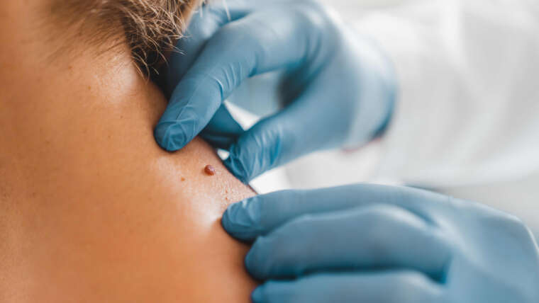 Skin Tag Removal in Navi Mumbai