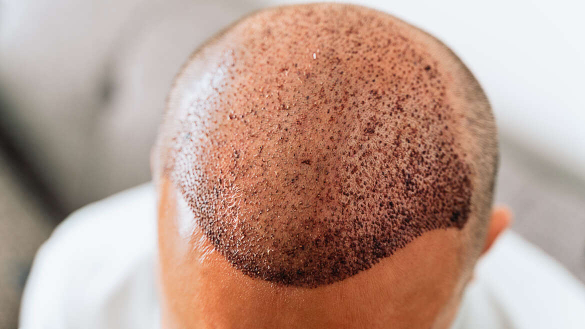 Hair Transplant and Plastic Surgery in Navi Mumbai