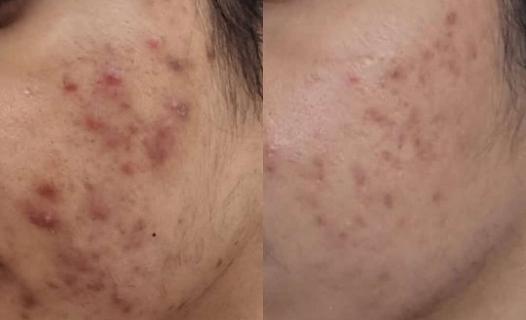 Acne and Acne Scar Treatment