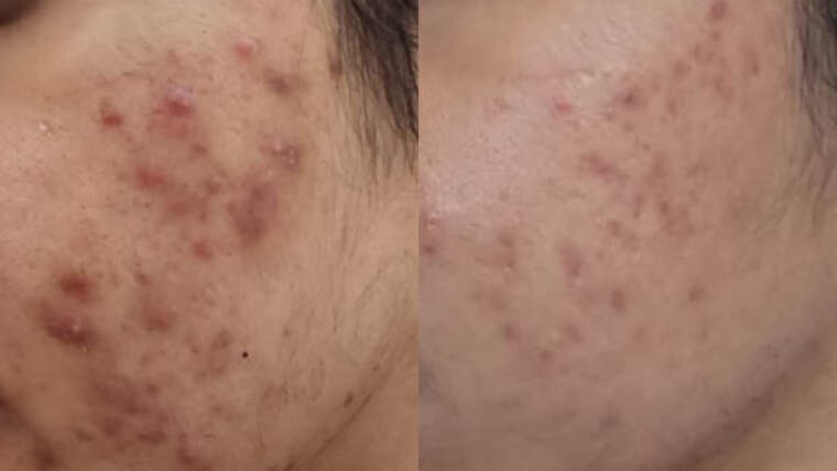 Acne Scar Treatment in Navi Mumbai