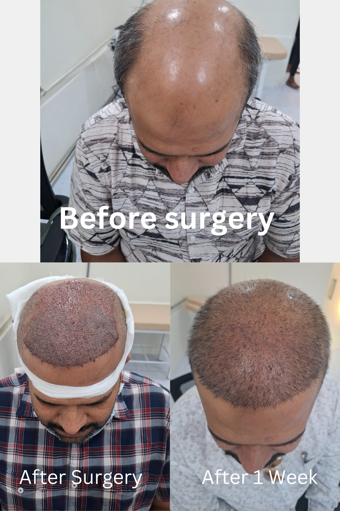 before after hair transplant surgery at mcderma navi mumbai