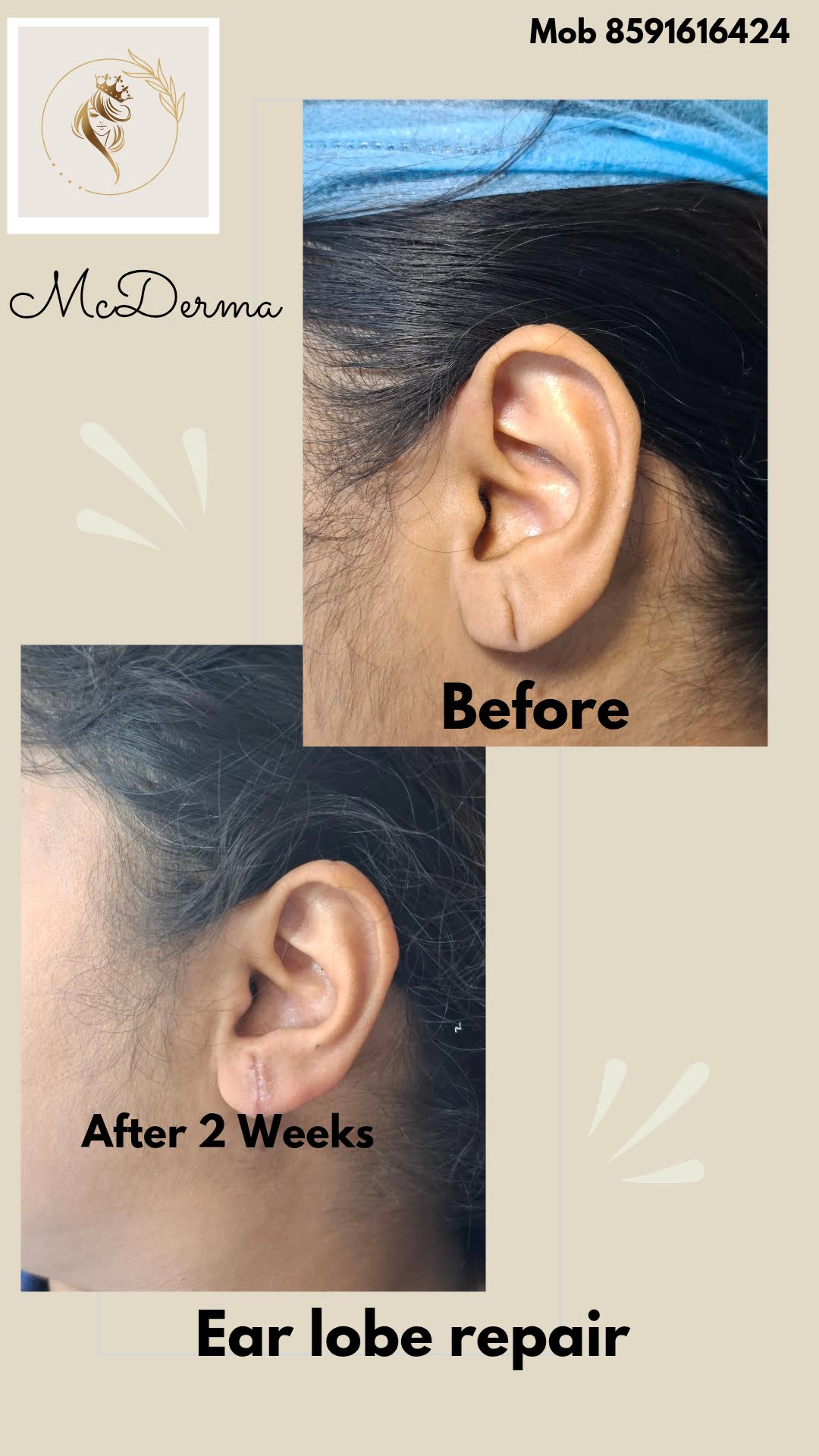 before after ear lobe repair at mcderma navi mumbai