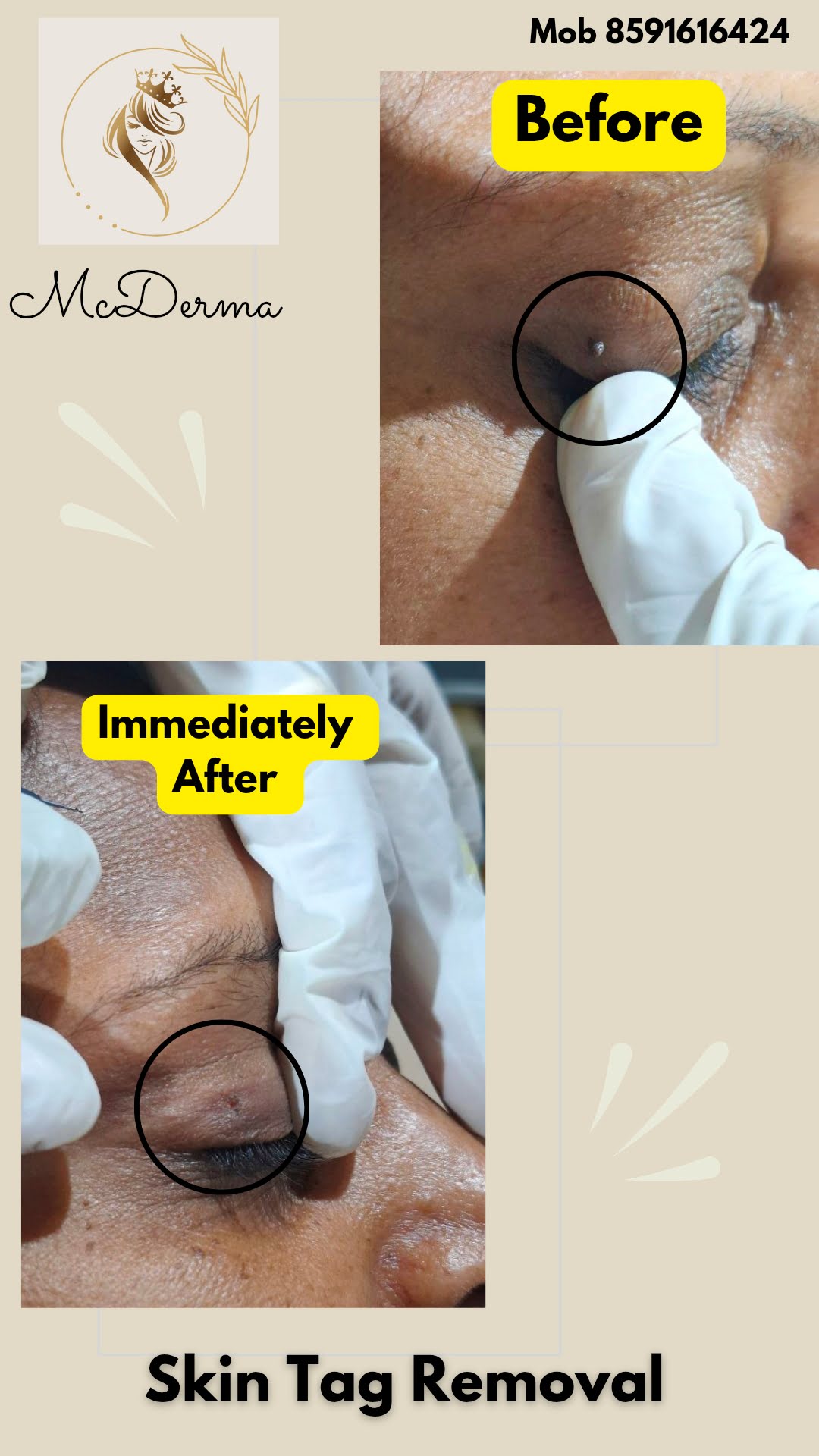 before after skin tag removal at mcderma navi mumbai