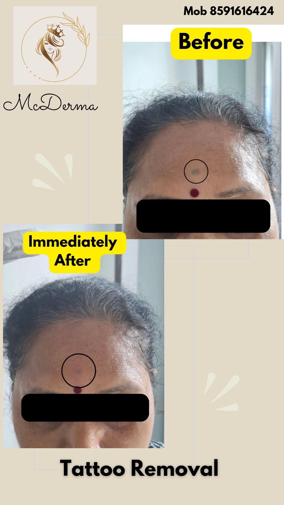 before after tattoo removal at mcderma navi mumbai